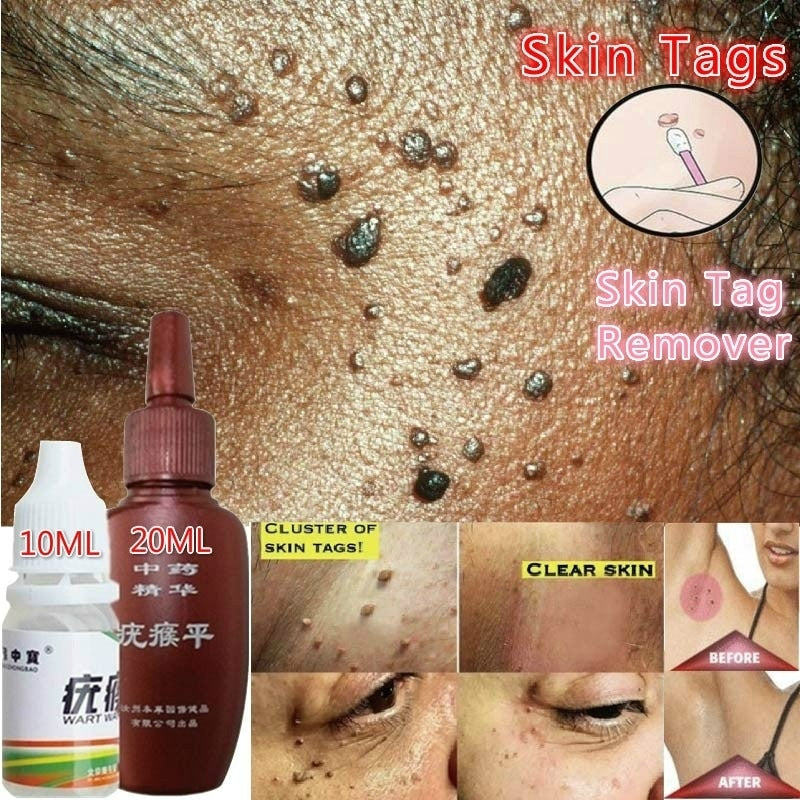 Skin Tag Remover Foot Treatment Mole Skin Tag Body Warts Remover Skin Care Tools(10/20ml )