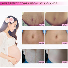 Load image into Gallery viewer, Stretch Marks Removal Essential Oils Pure Natural Stretch Marks Remover Obesity Postpartum Anti-wrinkle Repair Cream Skin Care
