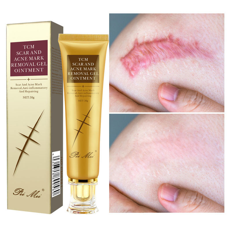 30/60g Acne Scar Removal Cream Face Gel Remove Acne Smoothing Whitening Pimples Stretch Marks Moisturizing Body Skin Care Aichun