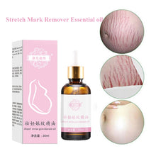 Load image into Gallery viewer, Stretch Marks Remover Essential Oil Skin Care Treatment Cream For Stretch Mark Removal Maternity Slackline For Pregnant Oils
